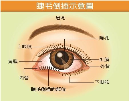 眼睫毛倒插到眼里-眼 睫毛 经常进到眼里怎么办