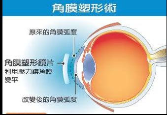 【近視保健】認識角膜塑型隱形眼鏡