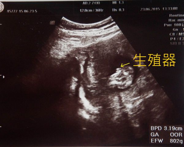 是男還是女？孕期徵兆到底準不準