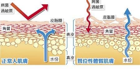 異位性皮膚炎猛擦藥沒效，洗澡後才是重點！