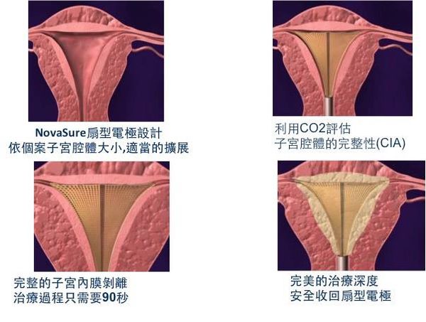 經血過多又痛,一勞永逸的「內膜破壞術」