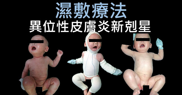異位性皮膚炎新剋星-濕敷療法