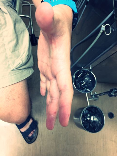 腸病毒絕非小孩特有疾病！大人也中標！