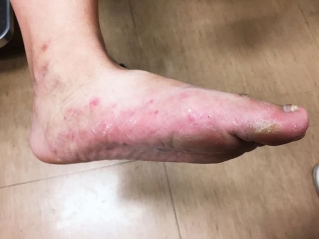 腸病毒絕非小孩特有疾病！大人也中標！