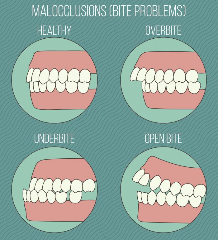 儿童咬合不正怎麼办?小心口腔健康亮红灯