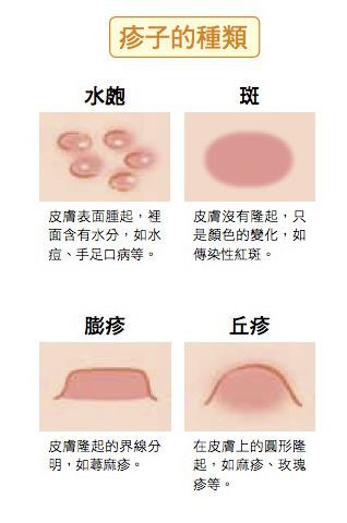 可以洗澡嗎?小孩起疹子七大疑問解答