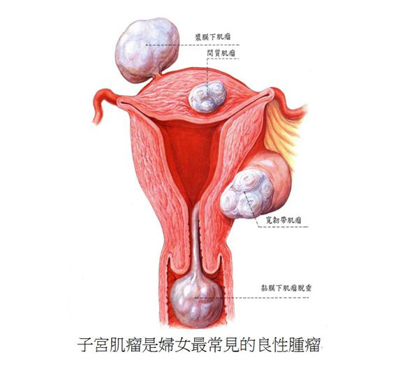女人一生的痛!子宮肌瘤多屬良性,但是不能輕忽