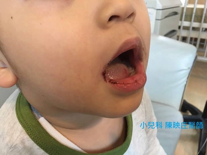 照顧者的錯！小兒常見(減肥型)傳染病：泡疹性齒齦炎
