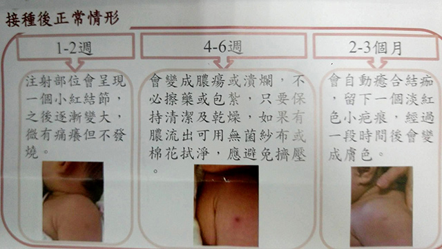 寶寶疫苗焦慮度排行榜第一名:卡介苗