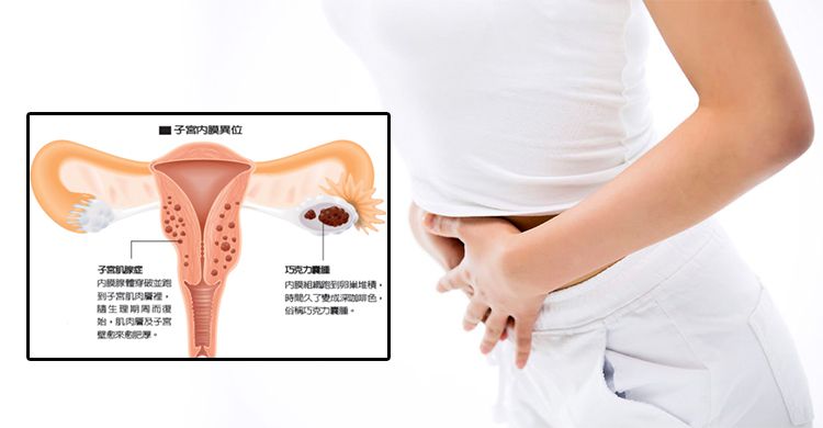 巧克力囊腫＝不孕？了解巧克力囊腫成因和後果！