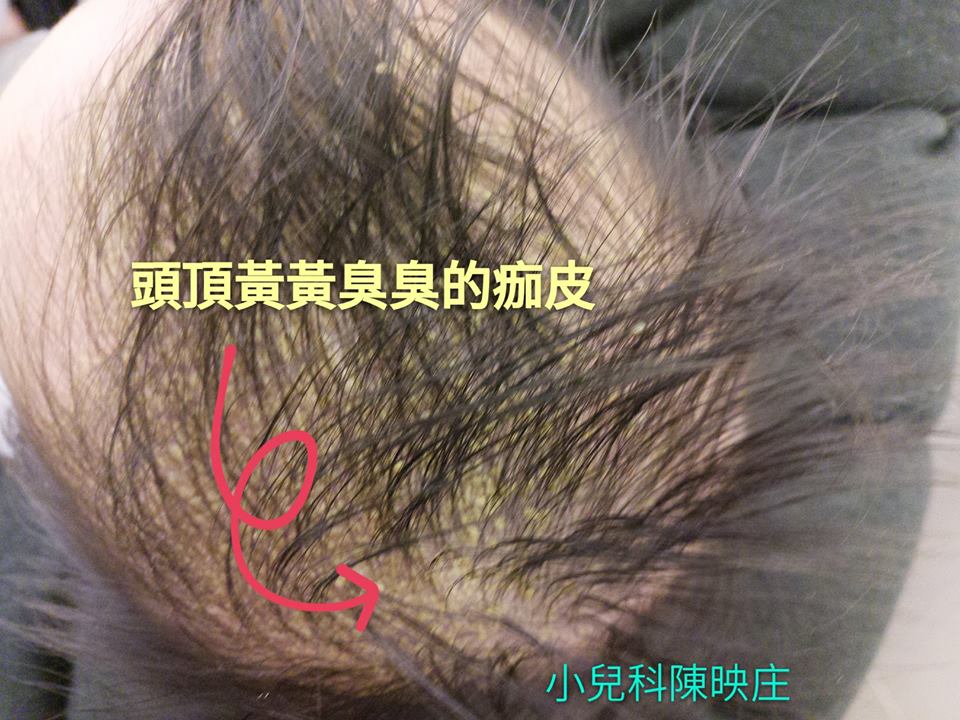 黃黃又臭臭!遇上脂漏性皮膚炎就來道麻油雞寶寶?