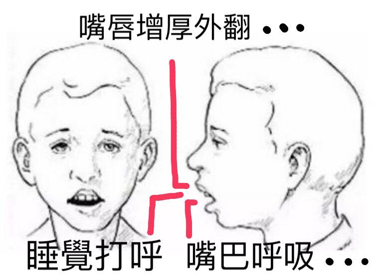 小孩睡覺打呼好可愛?長期導致嘴唇肥厚外翻和暴牙