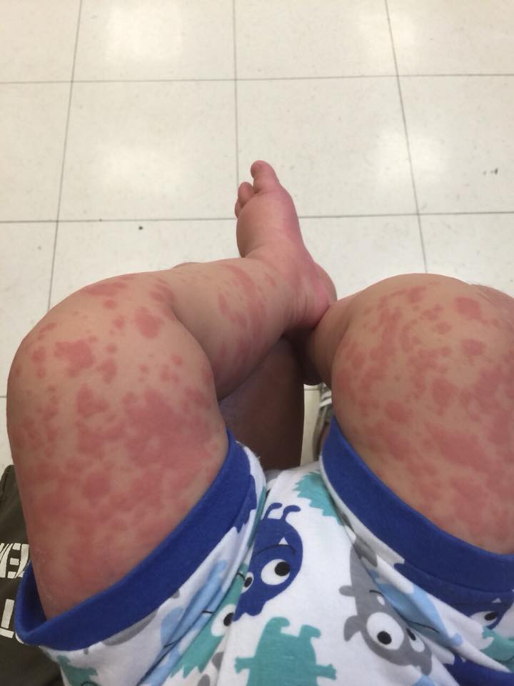 依依,人工受孕,高燒,起疹子,疹子,川崎症,心臟病患