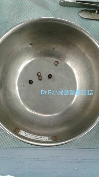 巴克球,磁力球,益智玩具,誤食,腸穿孔