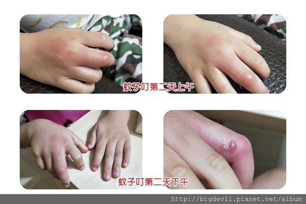 一隻蚊子搞死媽媽,蚊蟲叮咬水泡過敏反應,一周居家照顧紀錄