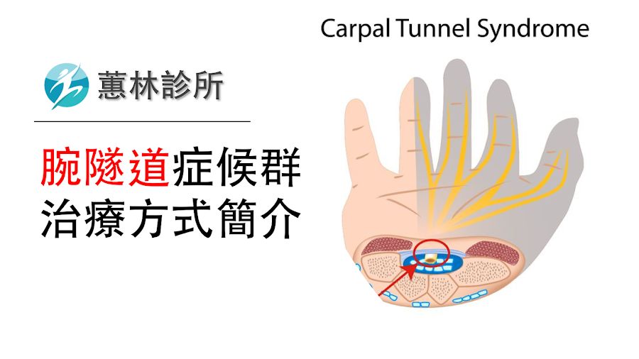 腕隧道症候群與治療方式簡介