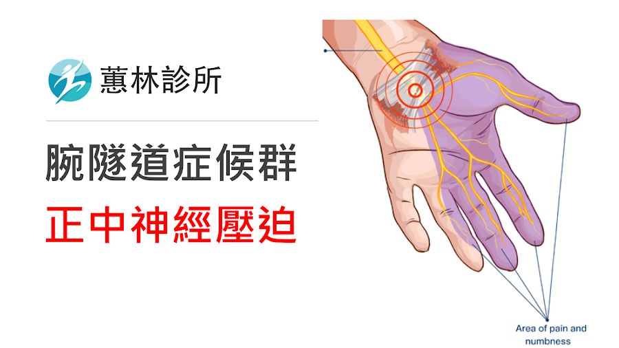 腕隧道症候群與治療方式簡介