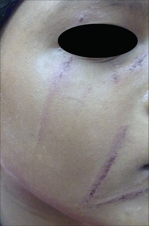 又癢又痛，神出鬼沒的隱翅蟲皮膚炎（青<a href='/?p=20906&utm_source=mamaclub.com&utm_medium=seo_keyword'>螞蟻</a>）