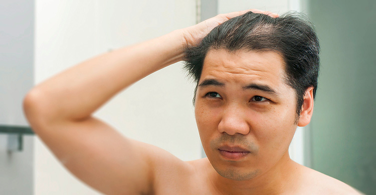 男性禿頭年輕化 七個方法避免落髮危機 媽媽經 專屬於媽媽的網站