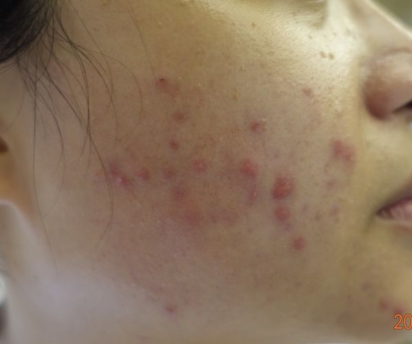 女性青春痘，五成內分泌失調