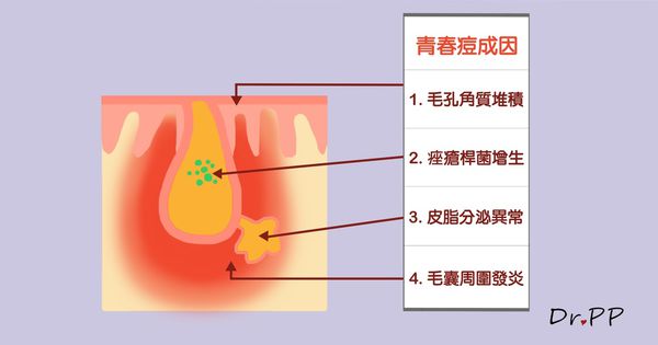 女性青春痘，五成內分泌失調