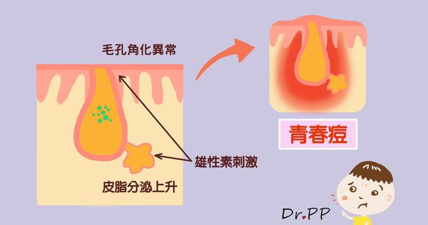 女性青春痘，五成內分泌失調