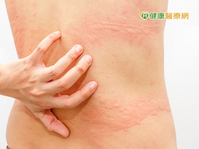 <a href='/?p=625927&utm_source=mamaclub.com&utm_medium=seo_keyword'>蕁麻疹</a>, 風疹塊,過敏原檢測,止癢,冰敷