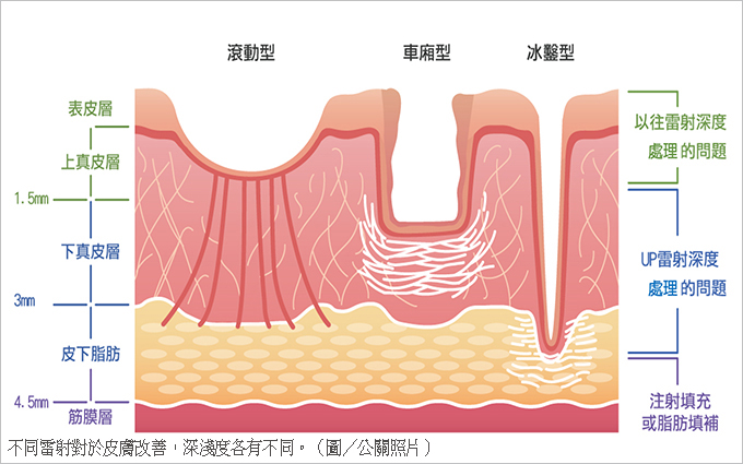 皮膚雷射