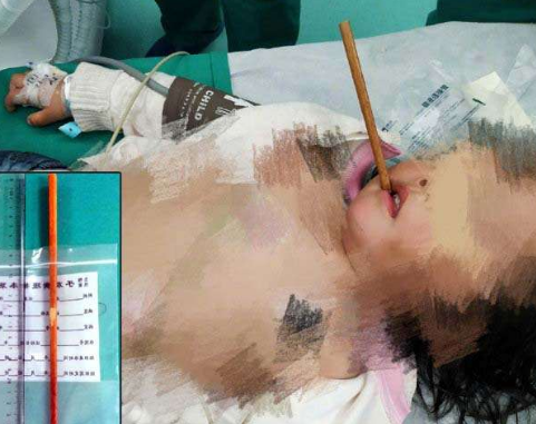 用餐安全 女童筷子插頭盧