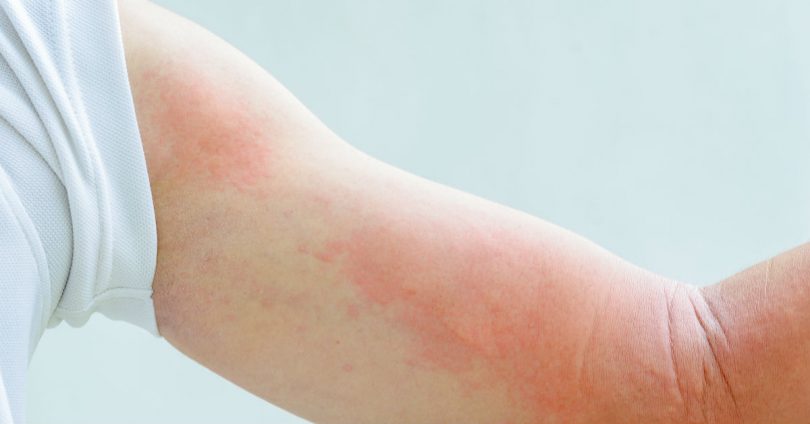 蕁麻疹越抓越癢怎麼辦 醫師教你如何治療保養