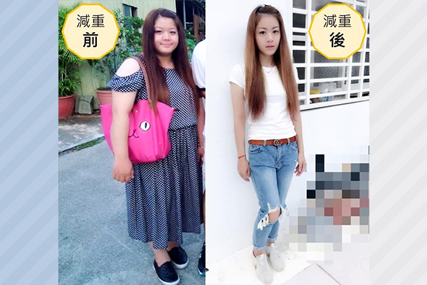 多囊性卵巢,肥胖,代謝異常,減重,胃切除,醫病共享