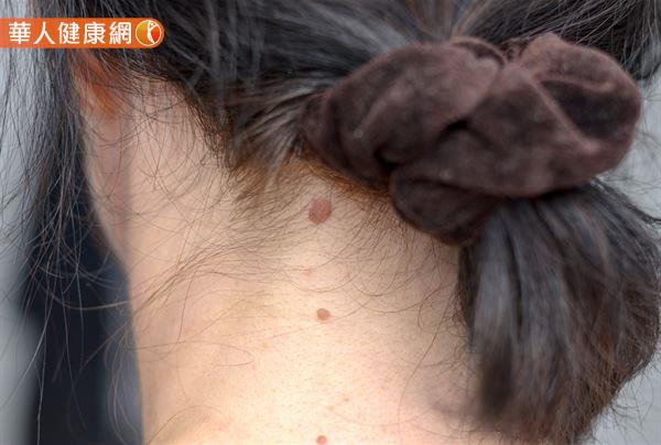 藝人楊皓如臉上長肉球誤以為 性病 竟是與菜花同種病毒的 扁平疣 媽媽經 專屬於媽媽的網站 藝人楊皓如臉上長肉球誤以為 性病 竟是與菜花同種病毒的 扁平疣 媽媽經 專屬於媽媽的網站