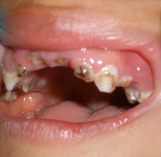蛀牙,牙菌斑,刷牙