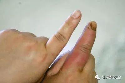 壞死性筋膜炎,蚊子咬