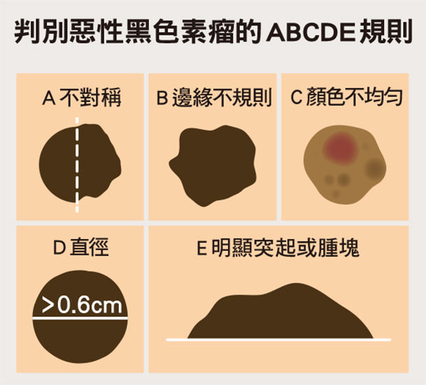 手 腳趾 腳掌冒黑痣要注意 恐是惡性皮膚癌 黑色素瘤 媽媽經 專屬於媽媽的網站