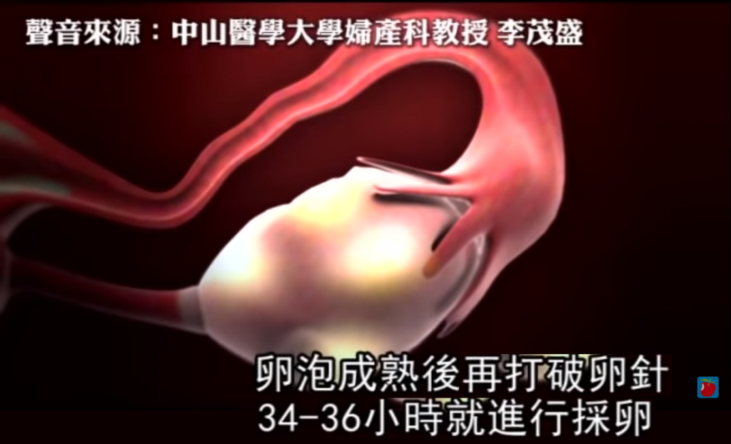 卵子,取卵,賣卵,捐精,捐卵,賺外快,卵巢過度刺激症候群,生育能力