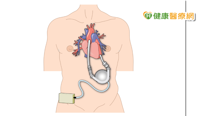 心臟加護,葉克膜,心室輔助器,人工心臟,器官捐贈