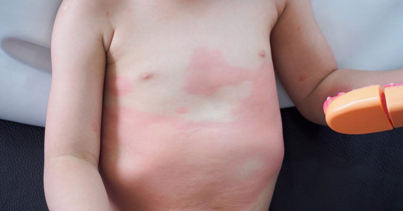 兒童常見過敏疾病 黴漿菌蕁麻疹 應視兩種不同症狀治療 媽媽經