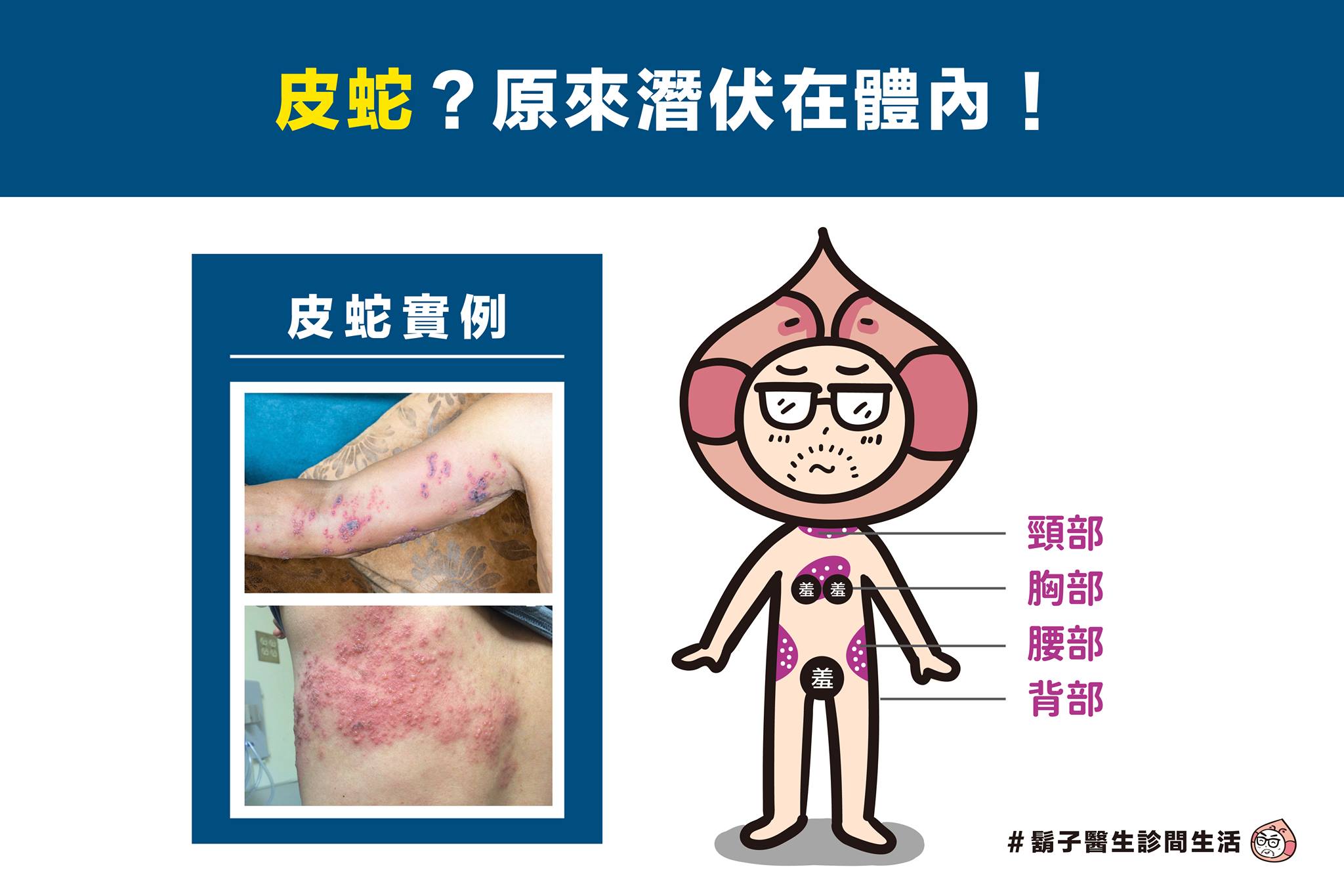 皮蛇,水痘,帶狀疱疹,神經痛,水痘疫苗