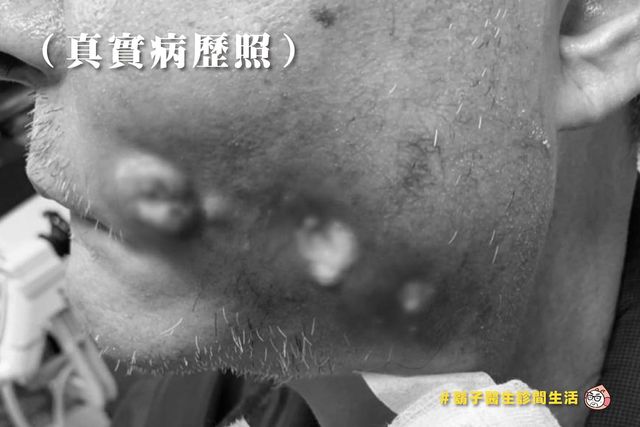 口腔癌,化療,電療,吃檳榔,止痛針,抽煙,喝酒,耳鼻喉科,口腔黏膜潰瘍