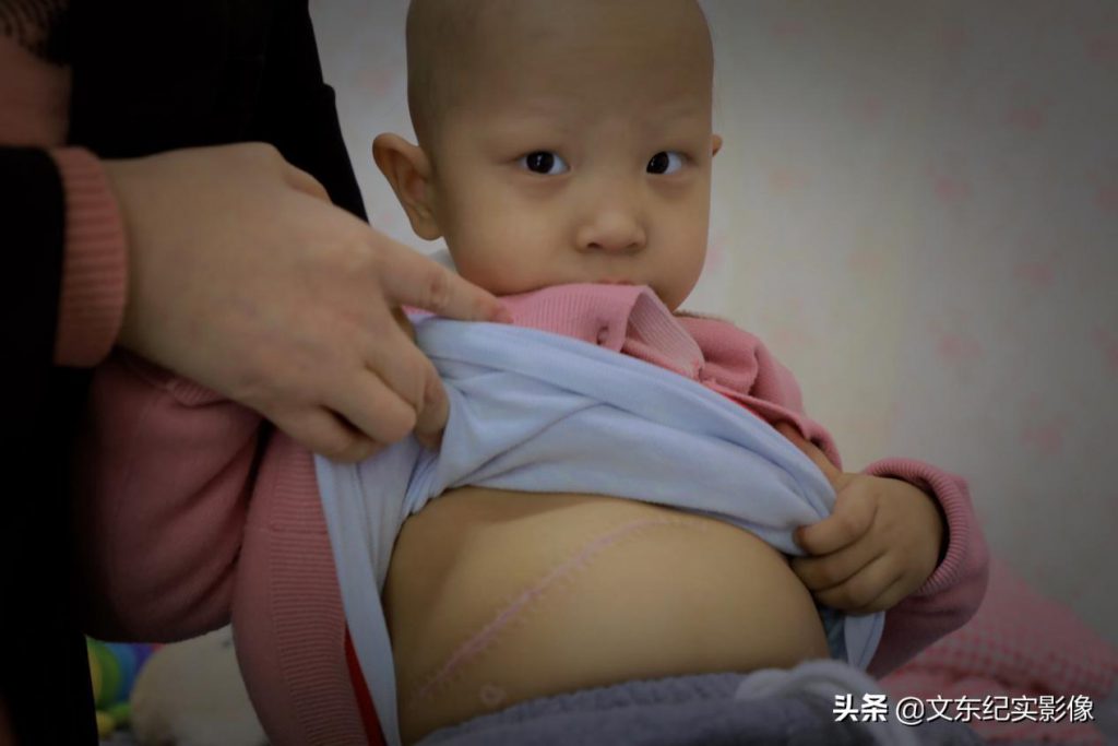 腦瘤,頭暈,眼睛複視,腦幹,吞嚥困難,化療,後遺症,神經母細胞瘤,兒童癌症,兒童罹癌