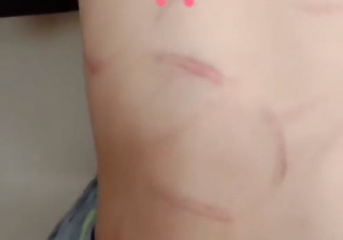 7歲男童被繼母打得傷痕累累
