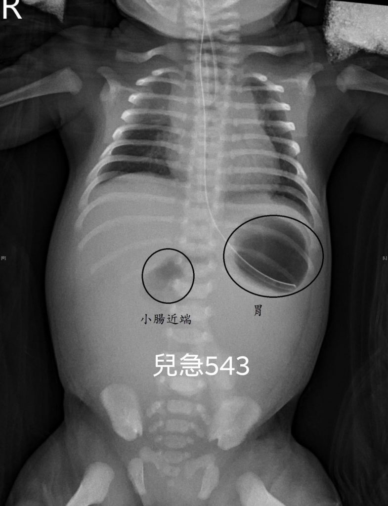 吳昌騰,小腸閉鎖,先天性十二指腸閉鎖,