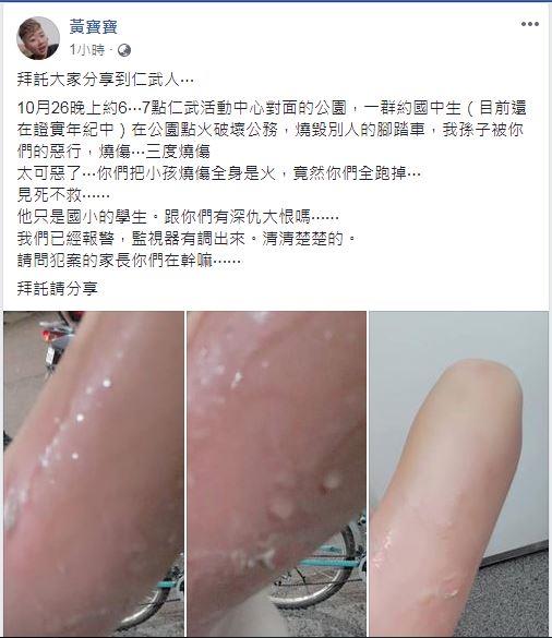 燙傷,傷疤,護理,燒燙傷,噴槍燒傷,傷燙傷處置,燒燙傷怎麼辦,小孩 燙傷,燒燙燒 治療