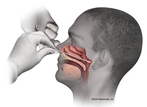 鼻咽檢測,新型冠狀病毒